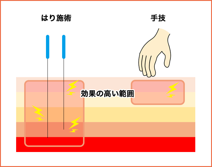 鍼施術のメリット