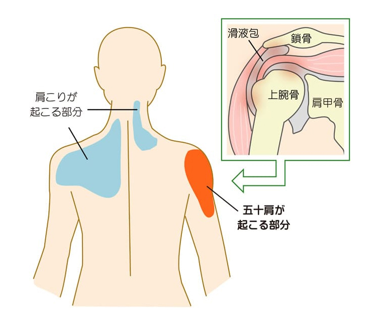 肩こりとその他の肩の症状図解